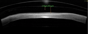 conjunctival-scarring-case-report-3