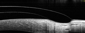 conjunctival-scarring-case-report-4