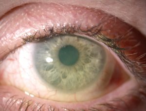 dry-eye-under-scleral