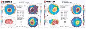 orbscan