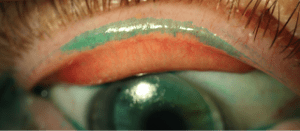 scleral_lens_01