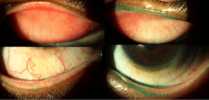 scleral_lens_02