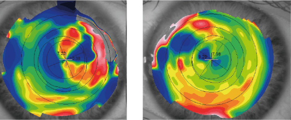 Salzmann's Nodular Degeneration