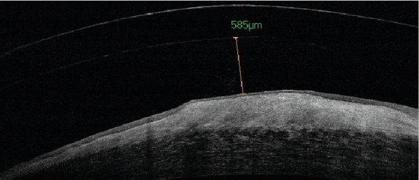 Salzmann's Nodular Degeneration