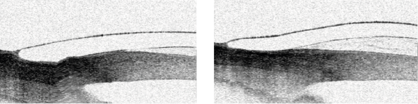 Evolution of Scleral Lens Fitting