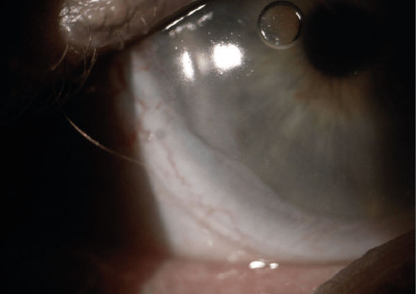 Conjunctival Prolapse