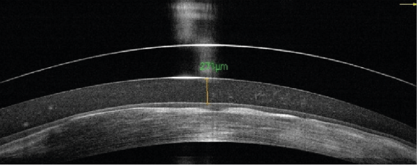 Evolution of Scleral Lens Fitting