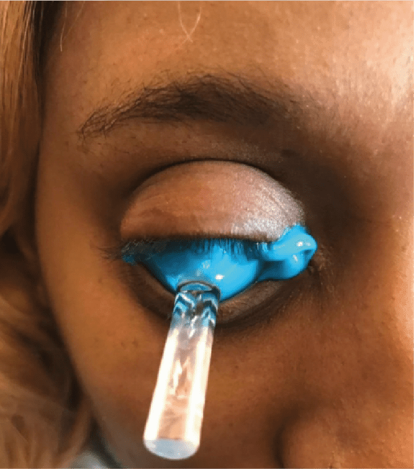 Scleral impression