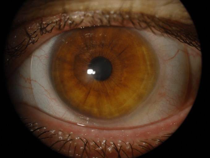 Scleral Lens for Keratoconus