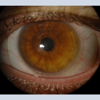 Keratoconus-Scleral-Lenses
