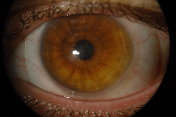 Keratoconus-Scleral-Lenses