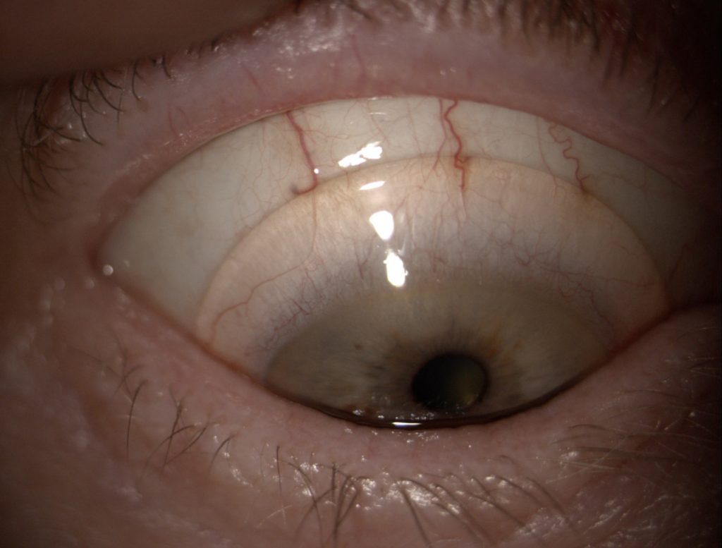 Dry Eye and Scleral Lenses in Optimum