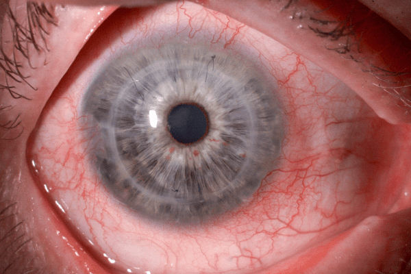Close up of cornea that was protected from blunt trauma with scleral lens