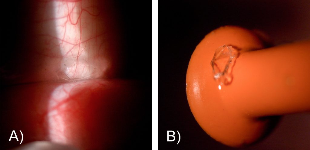 Blunt Trauma with Scleral Lens