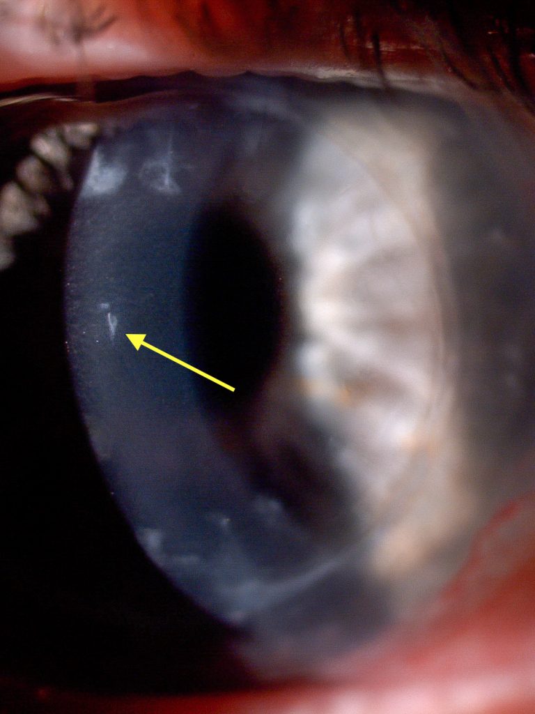 Small lesion in the centre of the cornea