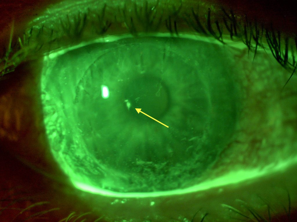 Blunt Trauma with Scleral Lens