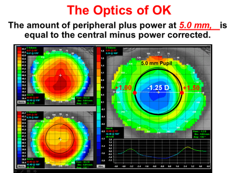 orthokeratology for soft lens dryness