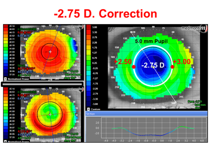 orthokeratology for soft lens dryness