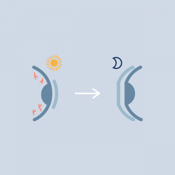 orthokeratology for soft lens dryness