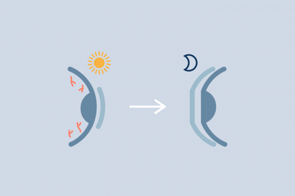 orthokeratology for soft lens dryness