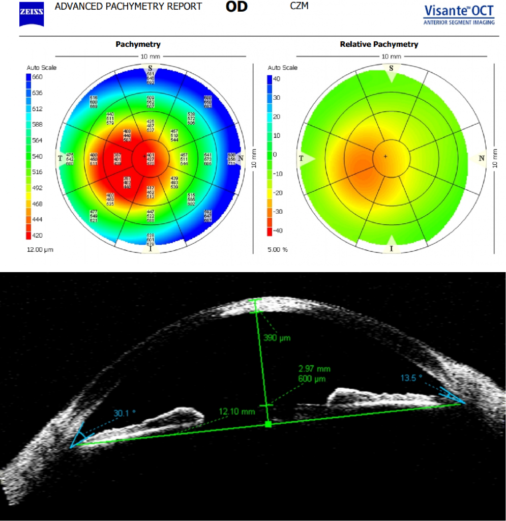 Abceso corneal con queratocono agudo