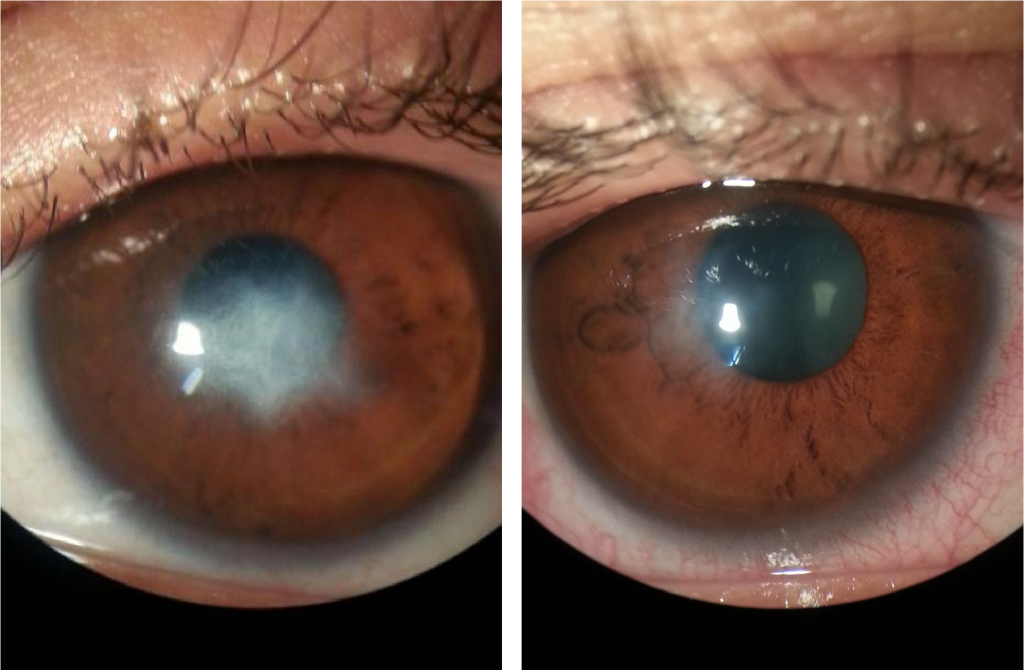 Abceso corneal con queratocono agudo