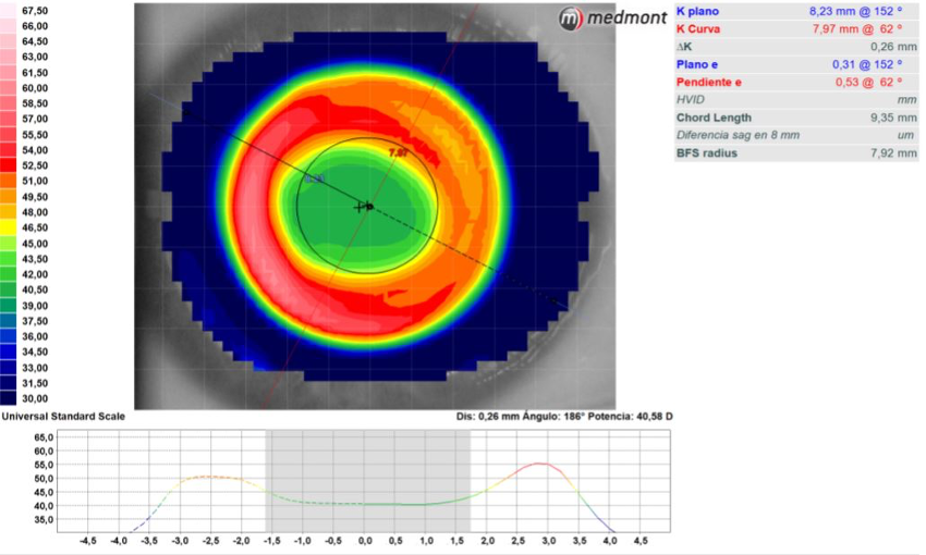 Dual Toric Orthokeratology Topography