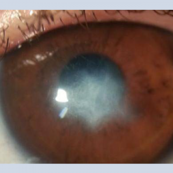 Corneal Abscess Acute Keratoconus