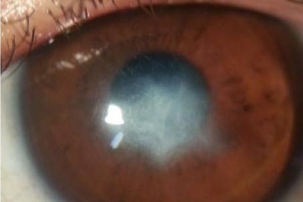 Corneal Abscess Acute Keratoconus