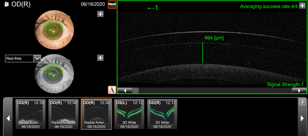 Keratoconus and Scleral Lenses