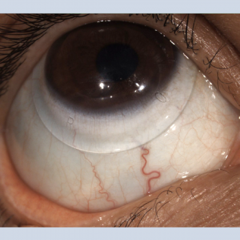 keratoconus scleral lens