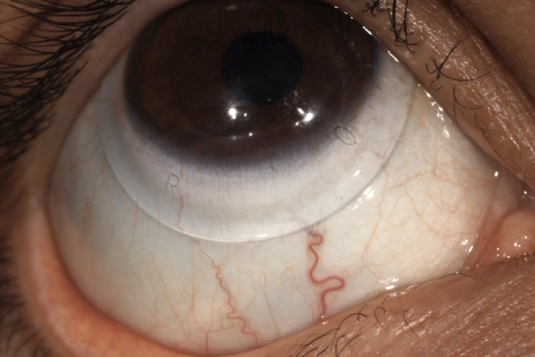 keratoconus scleral lens