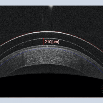 Radial Keratatomy And Reverse Geometry Scleral Lenses