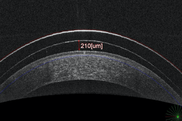 Radial Keratatomy And Reverse Geometry Scleral Lenses