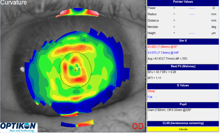 Ocular surface dystrophy corneal topography