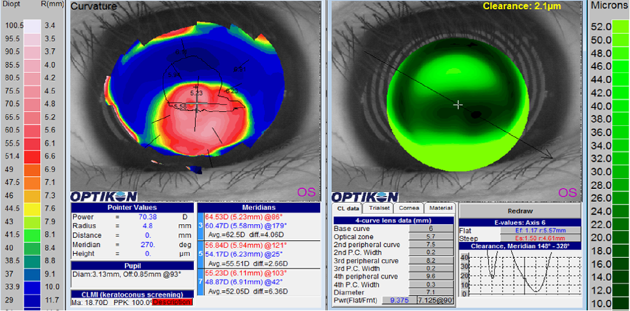 Keratometers vs Topographers