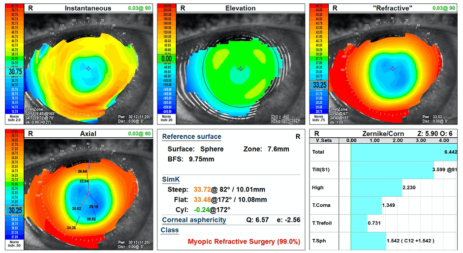 Reverse Geometry Scleral Lenses