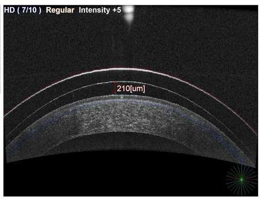 Reverse Geometry Scleral Lenses