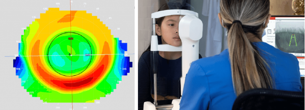 evolution of orthokeratology