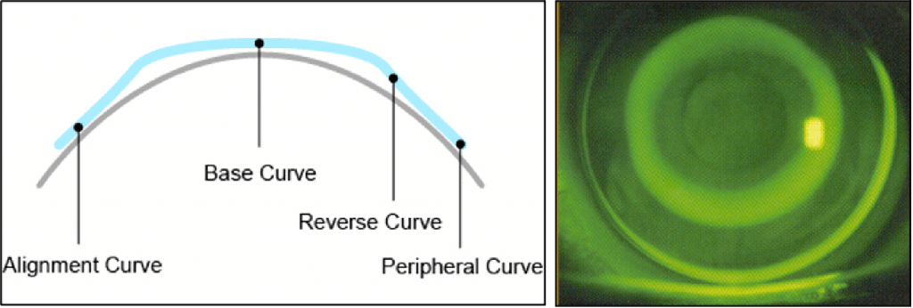 evolution of orthokeratology