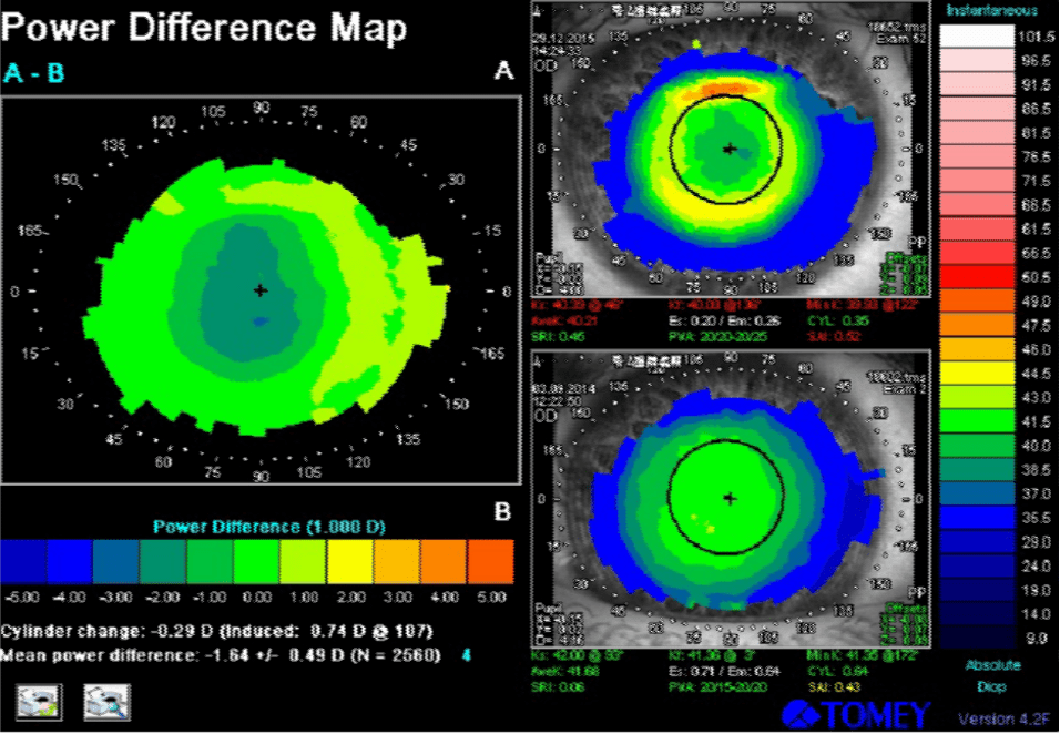 Ortho-k and the Emerging Myopic Child