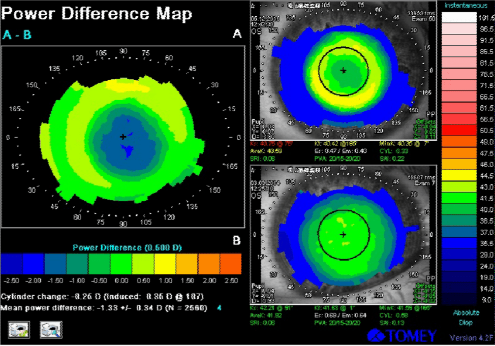 Ortho-k and the Emerging Myopic Child