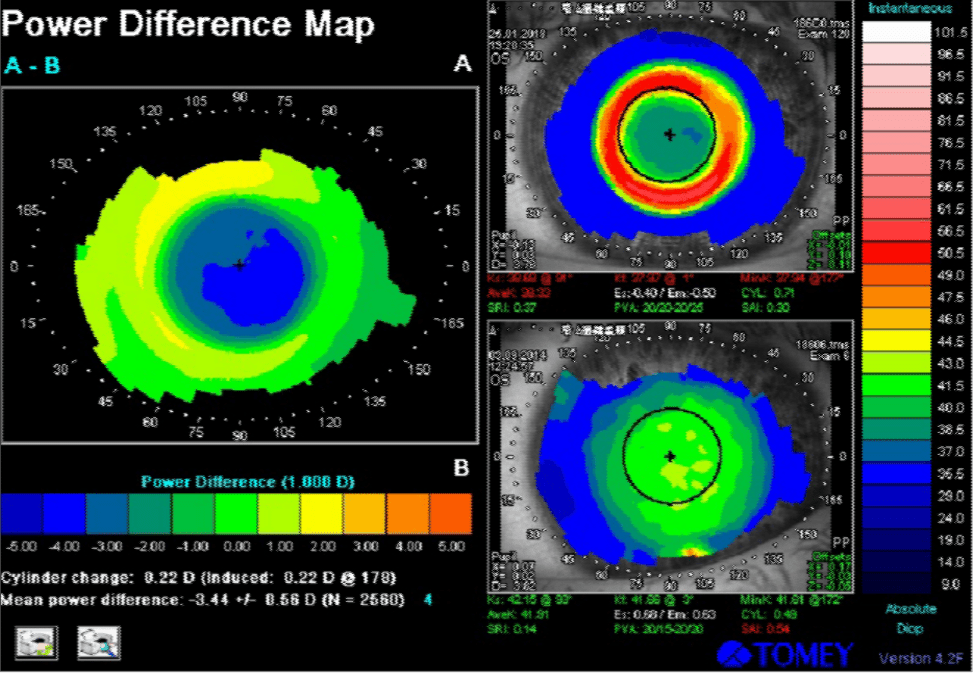 Ortho-k and the Emerging Myopic Child