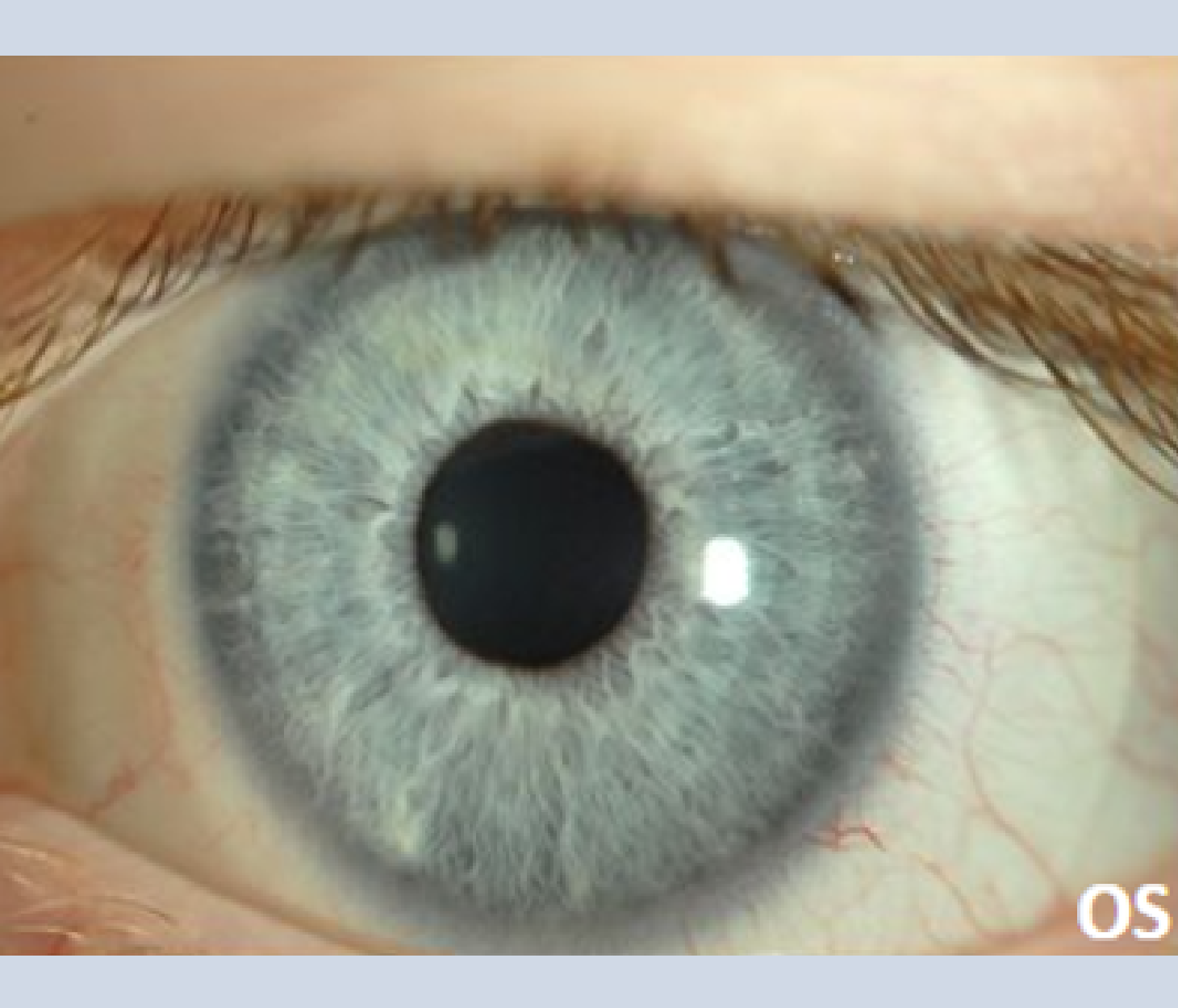 Haunted by Ghosting: HOA Correction in Keratoconus - Global Insight