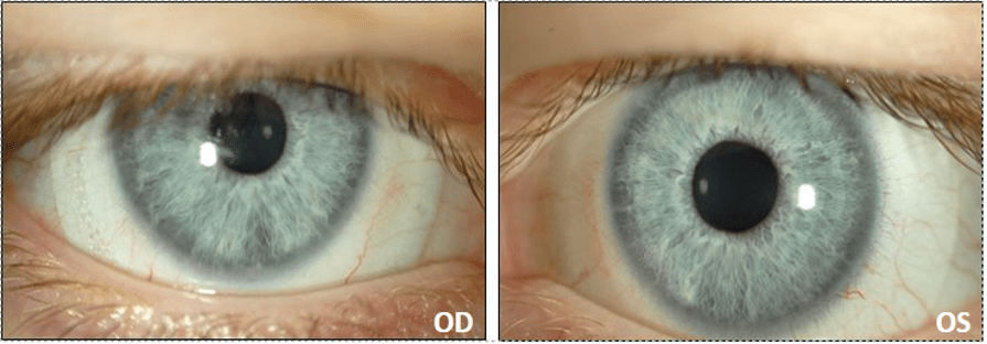 HOA Correction in Keratoconus