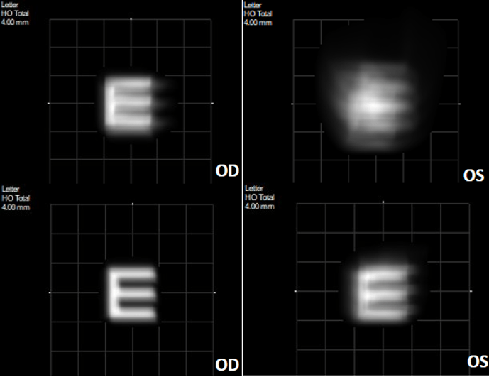 HOA Correction in Keratoconus