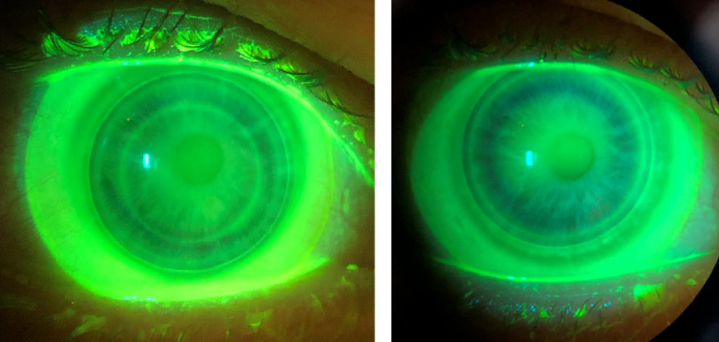 Keratoconus Hybrid Lens