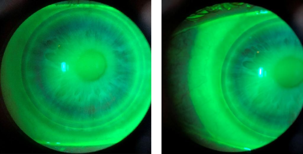 Keratoconus Hybrid Lens