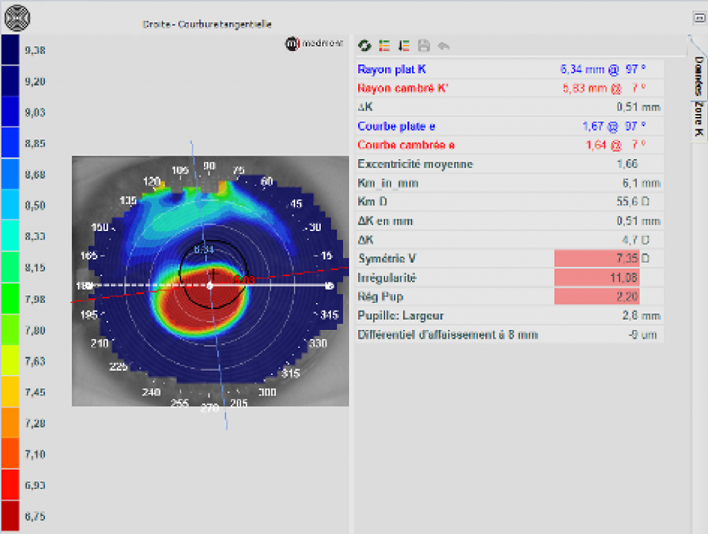 Bilateral Keratoconus