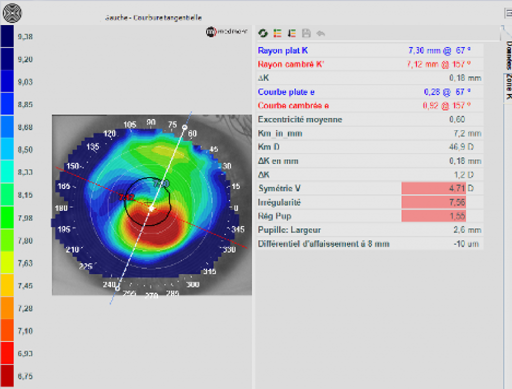 Bilateral Keratoconus